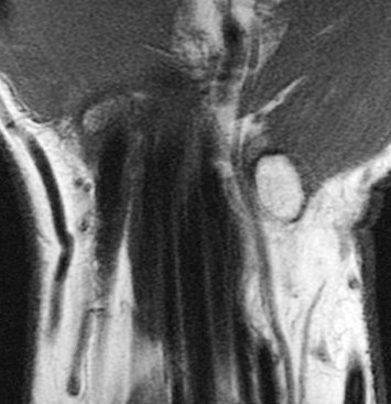 Figure 3 for case trapezial tubercle fracture ( RID2193 )